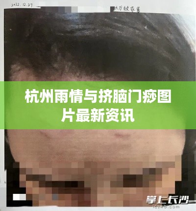 杭州雨情与挤脑门痧图片最新资讯