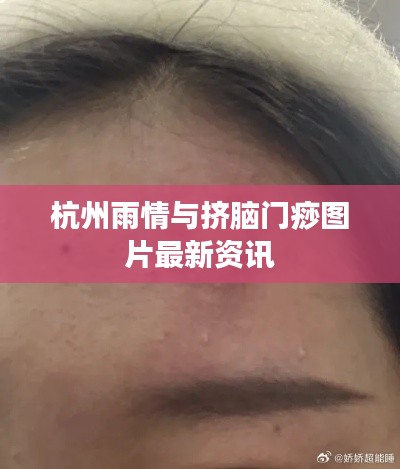 杭州雨情与挤脑门痧图片最新资讯